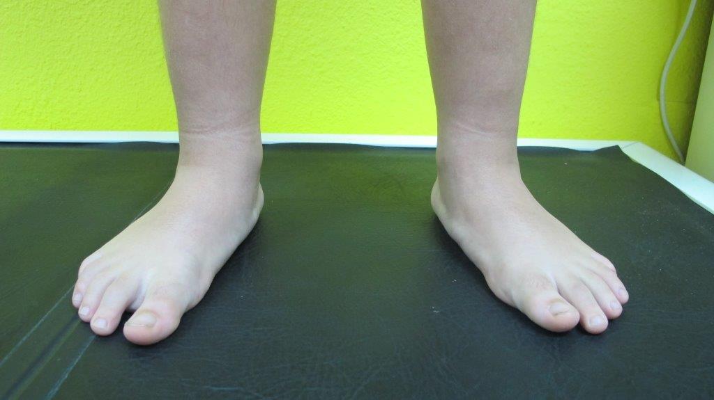 pies planos en niños podologo infantil malaga