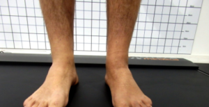 sindrome sudeck sindrome sudeck