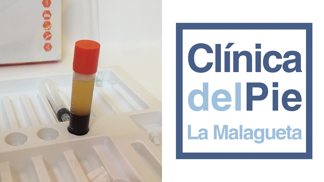 podologia Malaga cabecera plasma rico en plaquetas