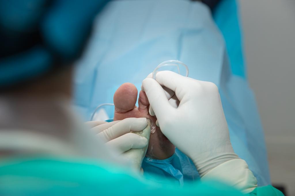 tratamiento neuroma de morton