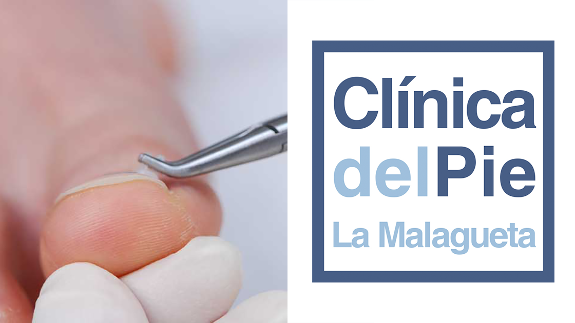 Podologo en Malaga cabecera tratamiento uña clavada