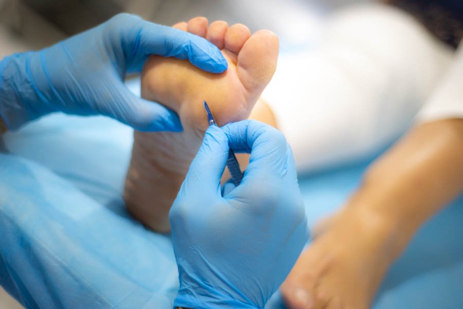 quiropodia malaga eliminar durezas en los pies