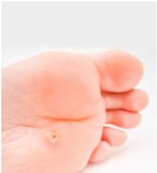 hiperqueratosis málaga