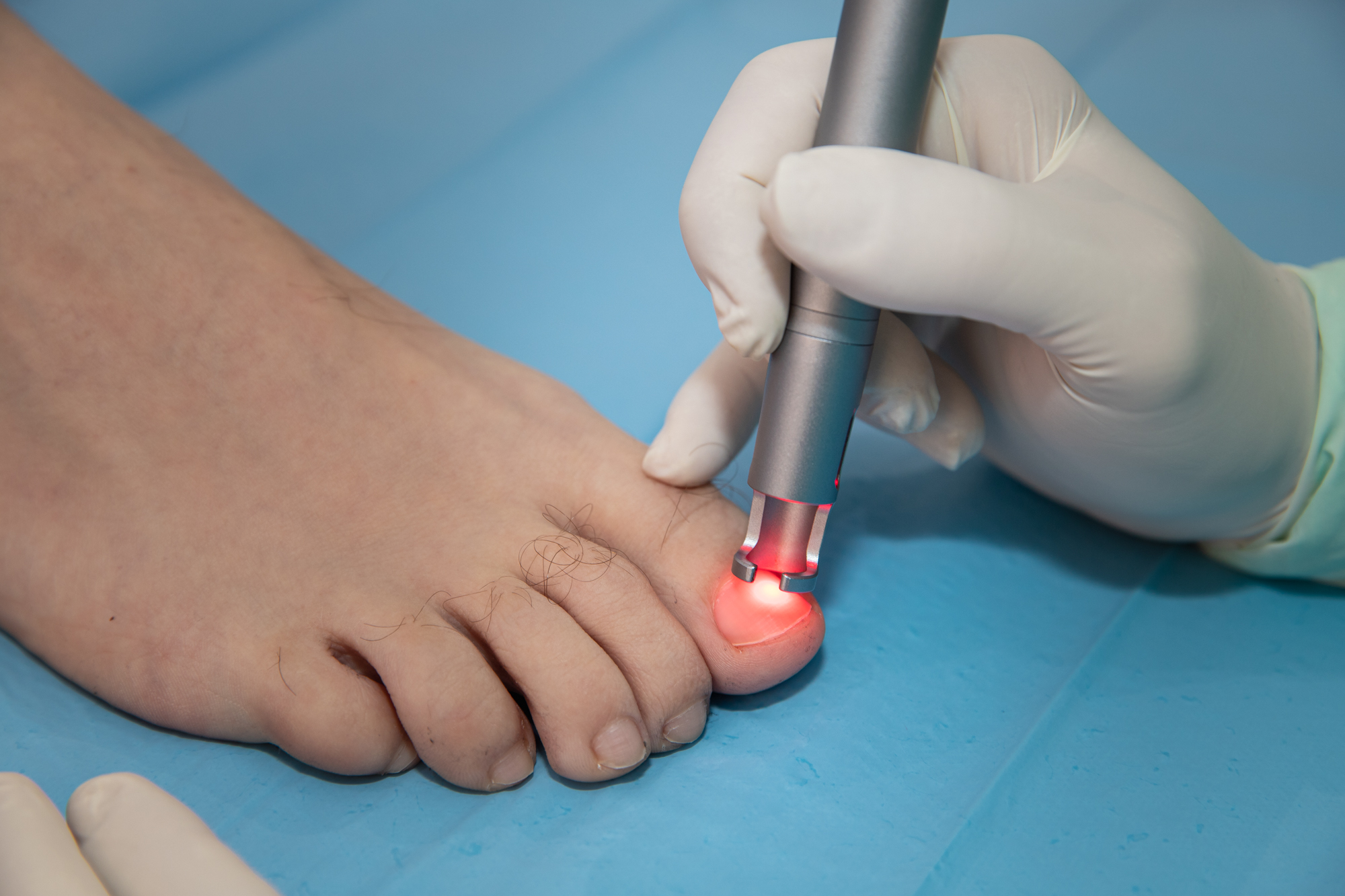 clinica del pie laserterapia 2
